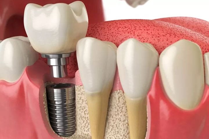 Implantes dentários: características e vantagens